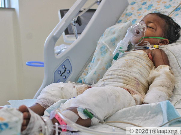 Baby Girl's Body Is Completely Burnt After Falling In Boiling Water