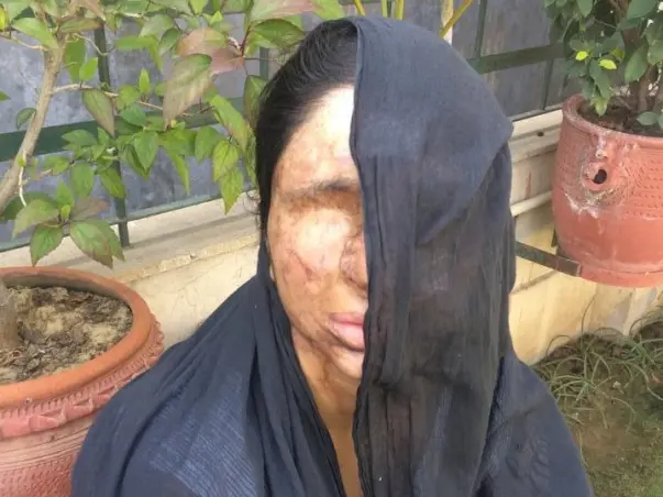 I am fundraising to help acid attack survivor Sheela