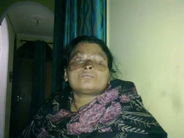 Fundraising to  help acid attack survivor Anu undergo a medical surgery. Join this cause!