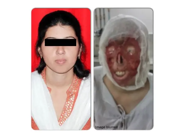 I am fundraising to help acid attack survivor Deepmala with her medical treatment