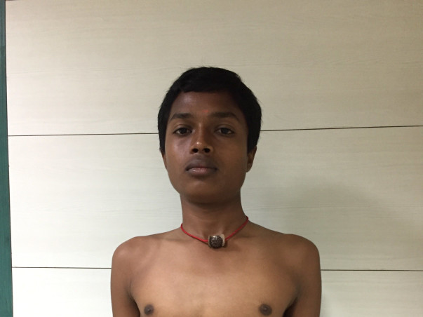 Help 18 year Old Harshavarthan Undergo Spinal Deformity Treatment