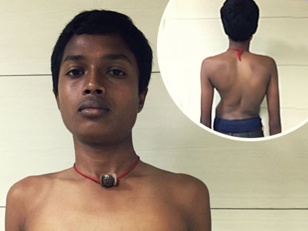 Help 18 year Old Harshavarthan Undergo Spinal Deformity Treatment
