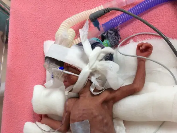 Help Baby of Sumedha Get Ventilator Support