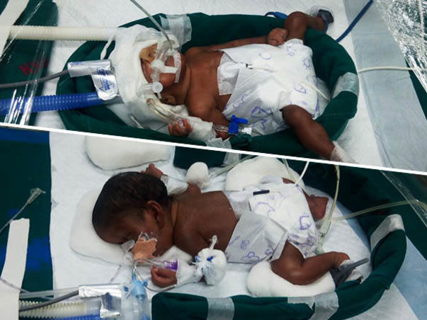 Help Premature New Born Twins To Survive