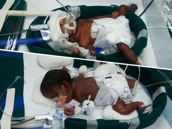 Help Premature New Born Twins To Survive