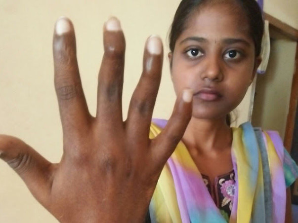 Help Pallavi With Her Hand Surgery To Write Again