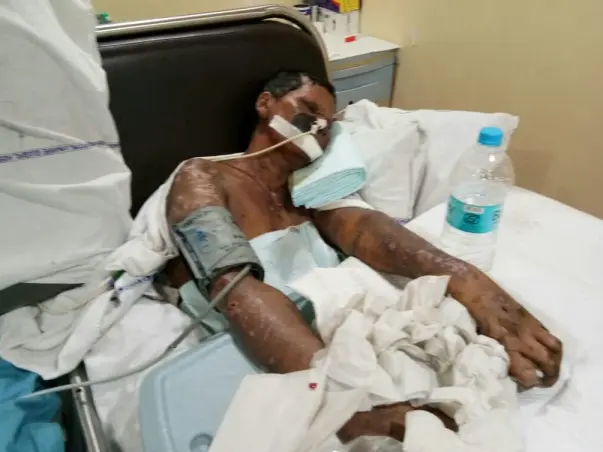 40-year-old Shevanta urgently needs  treatment for severe skin disease