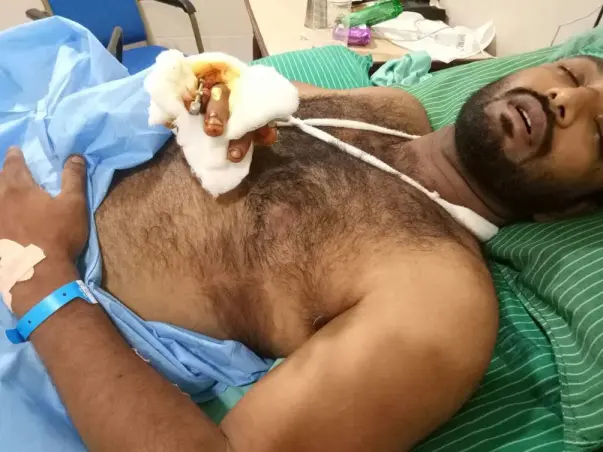 Help Muthu, An Athlete who lost his leg to walk again