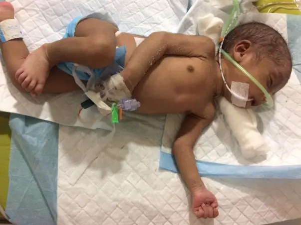 Reema's new born is on life support and fights to survive