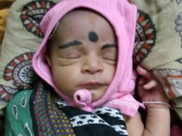 Baby sonali Heart surgery