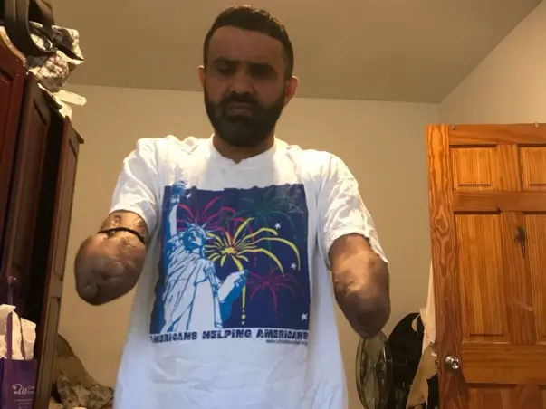 Help Param Get Prosthetic Hands.