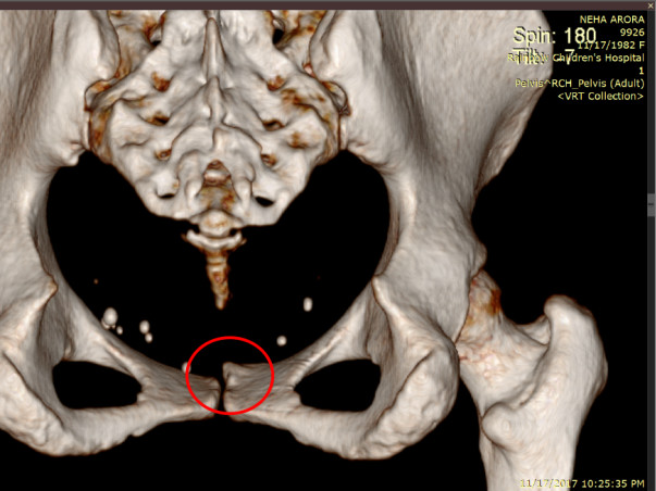 Neha Suffers From Intersititial Cystitis - PFD & Unbearable Pubic Pain