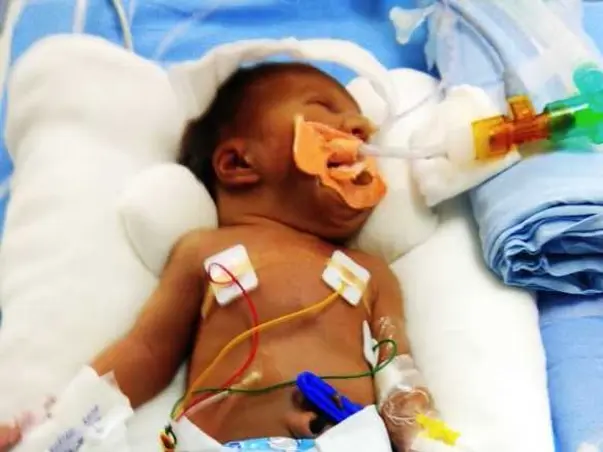 Baby of Humera begum fighting with lungs infections  and   heart