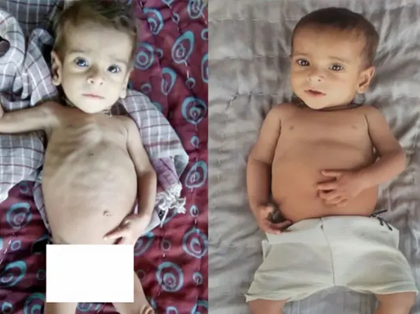 You can save lives of 500 malnourished children in Rajasthan!