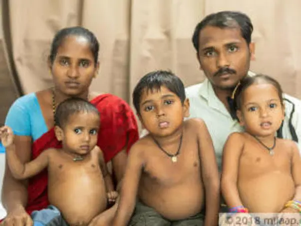 Poor Parents' All 3 Kids Have Severe Liver Disease, Need Urgent Help