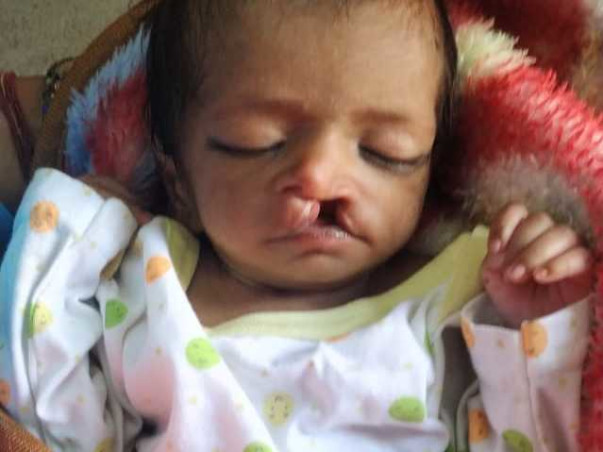 Help Little Tanvi, Kindly Donate And Help