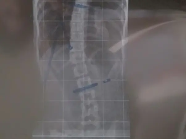 Help greeshama(spinal bend)