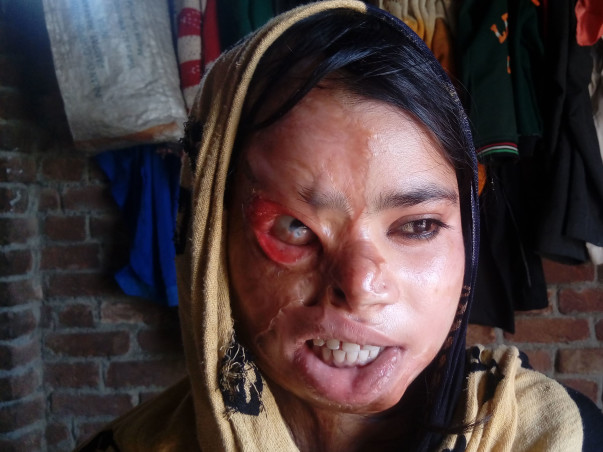 Help For Acid Survivors Cafe