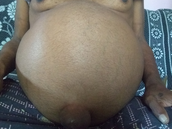LIVER transplant