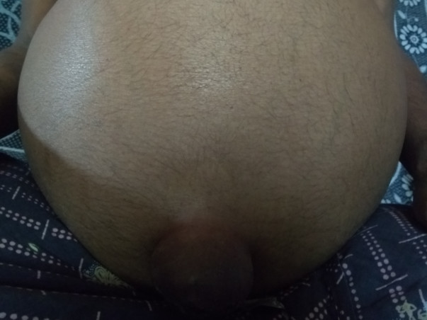 LIVER transplant
