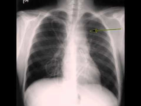 Help Prem Get Treated for Hodgkins Lymphoma