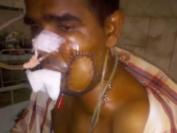 Support Mukesh Kumar Singh recover from Oral Cancer