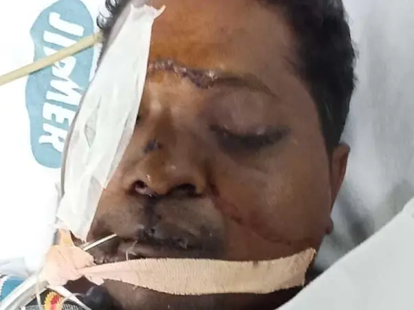 Help Solomon Arputharaj To Recover From The Dangerous Road Accident