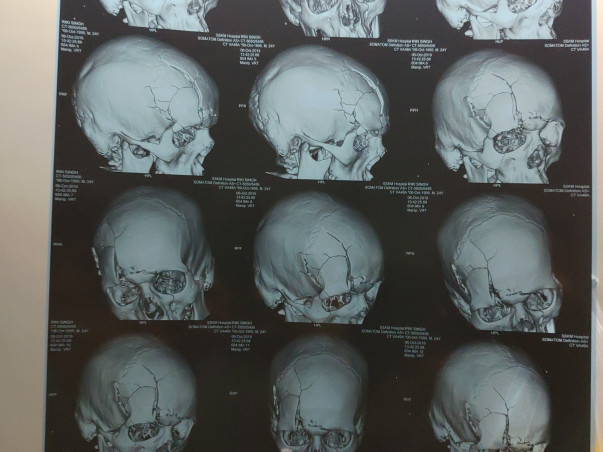 My Brother Is Struggling With Multiple Skulls, Facial Bones Fracture And Brain Injury, Help Him