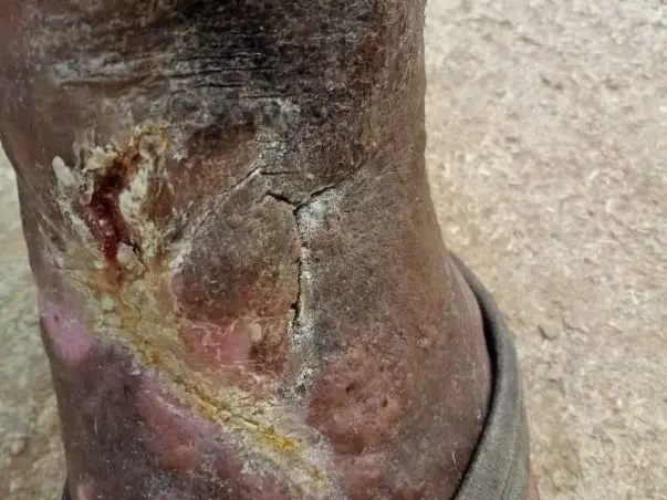 Support Satyanarayana Recover From Ulcer Wound In Left Leg