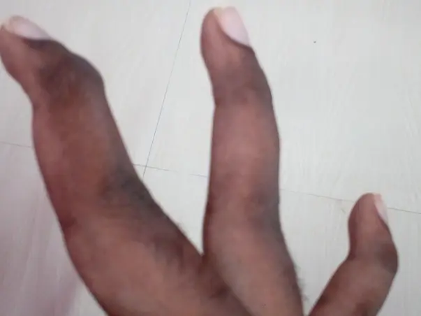I’m struggling with Fractured fingers, help me