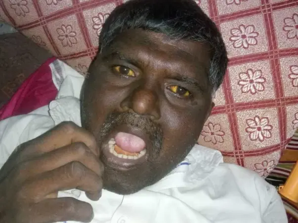 Help My Brother Recover From Liver Damage