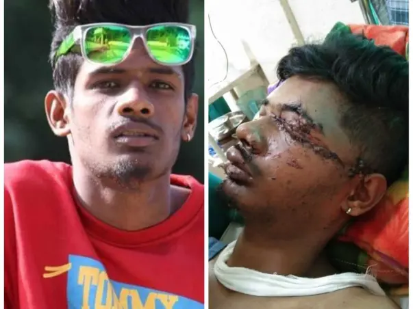Support Sandeep Recover From Accident (Leg Injury)