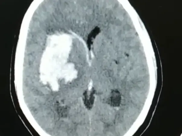 51 Years Old Sudha Jagadishan Needs Your Help Fight Brain Haemorrhage