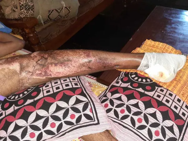 Support Sagar Recover From Accident (Leg Injury)