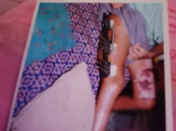 Support Viswanathan Recover From Leukemia And Accident(Leg Injury)