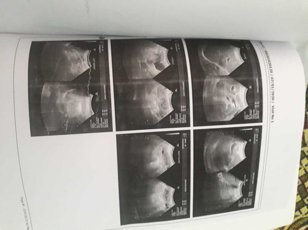 Help Selvi Undergo Kidney Transplant