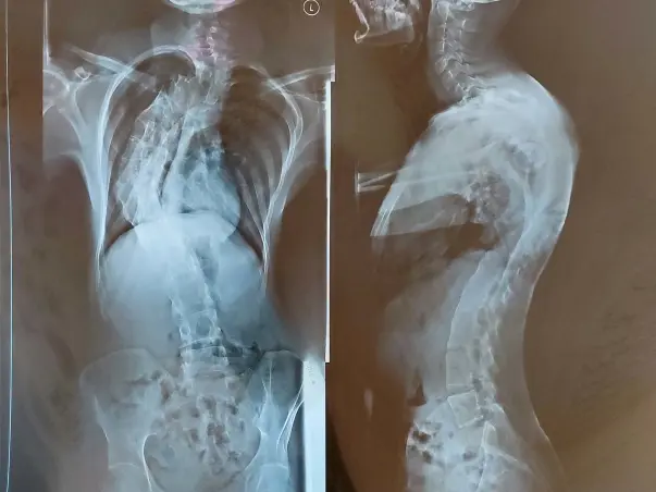 Need Your Help To Cure My Scoliosis