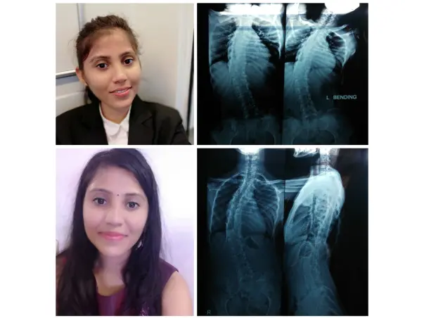 This 24 years old Pooja needs your support in fighting Spine Scoliosis