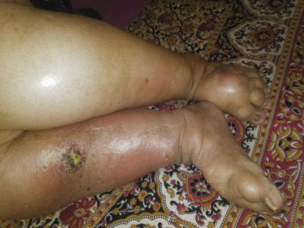 Support Uma Rao recover from Multi Organ Failure