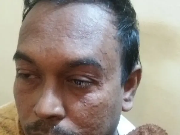 Support Paul Recover From Extreme Psoriasis
