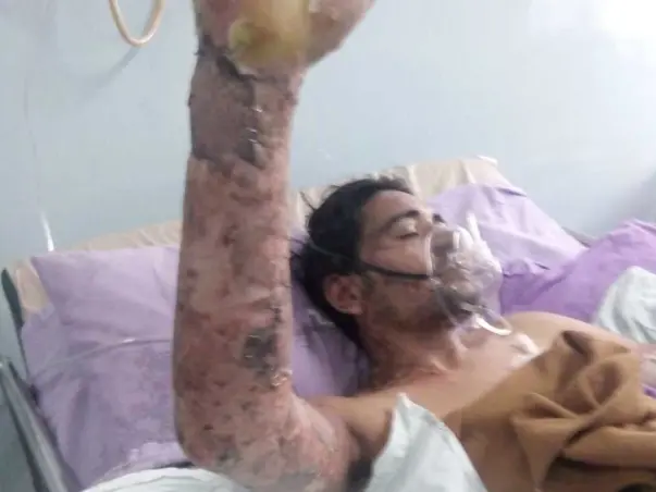 Help Prakash Recover From Severe Burns