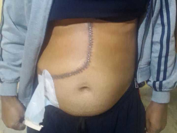 Support Vriti Kishor Recover From Acute Liver Failure