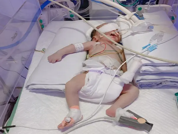 New Born Baby developed problems in breathing and needs to be kept on support.