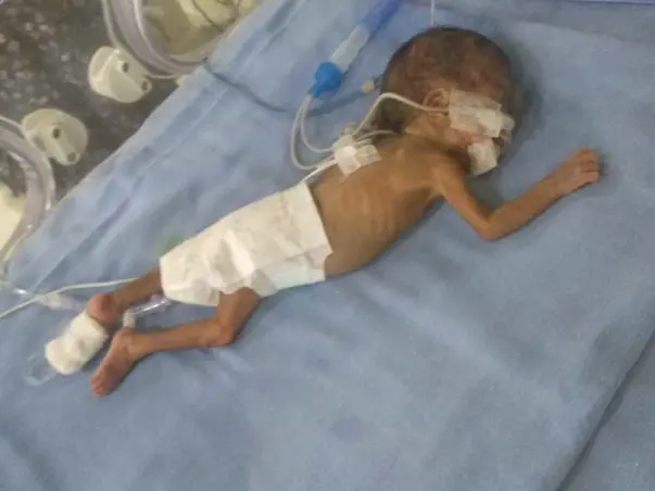 Help Me Save My 69-Days Old Baby