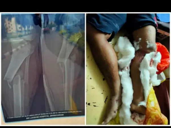 This 22 Years Old Needs Your Urgent Support To Ungergo Surgery