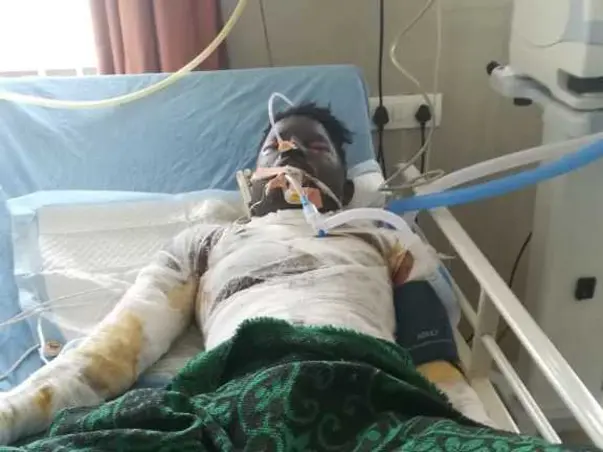21 Years Old Mahadevappa Talwar Needs Your Help Fight Severe Burns