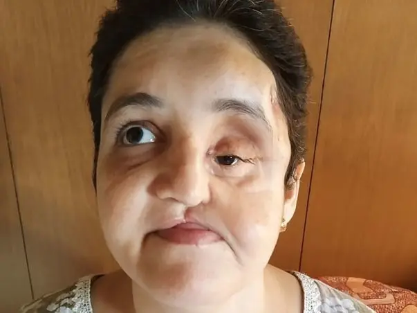 I’m Struggling With Brain Tumour, Help Me