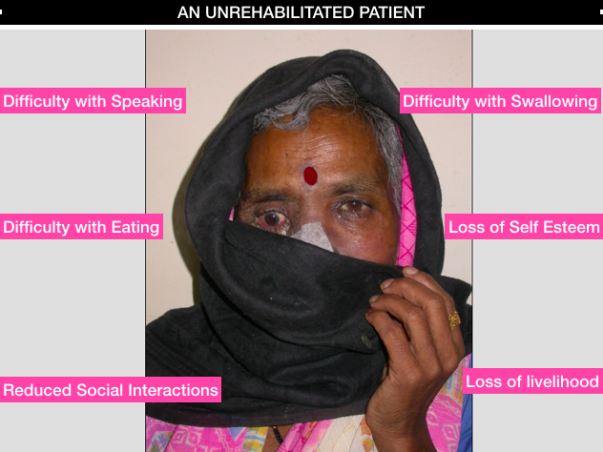Head And Neck Cancer Patients need Rehabilitation