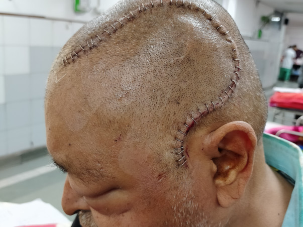 Support KRISHAN  fight/recover from Giant cell glioblastoma grade iv (brain tumor)