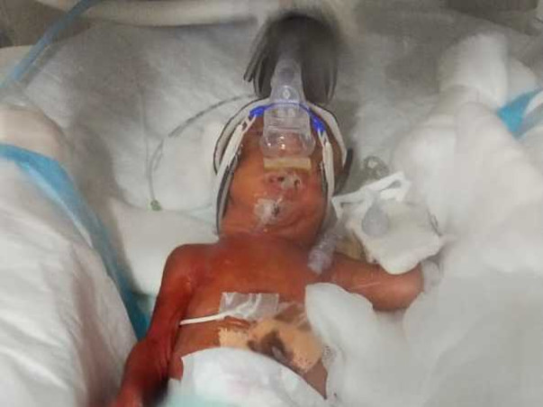 My nephew is struggling with Premature Birth, help him